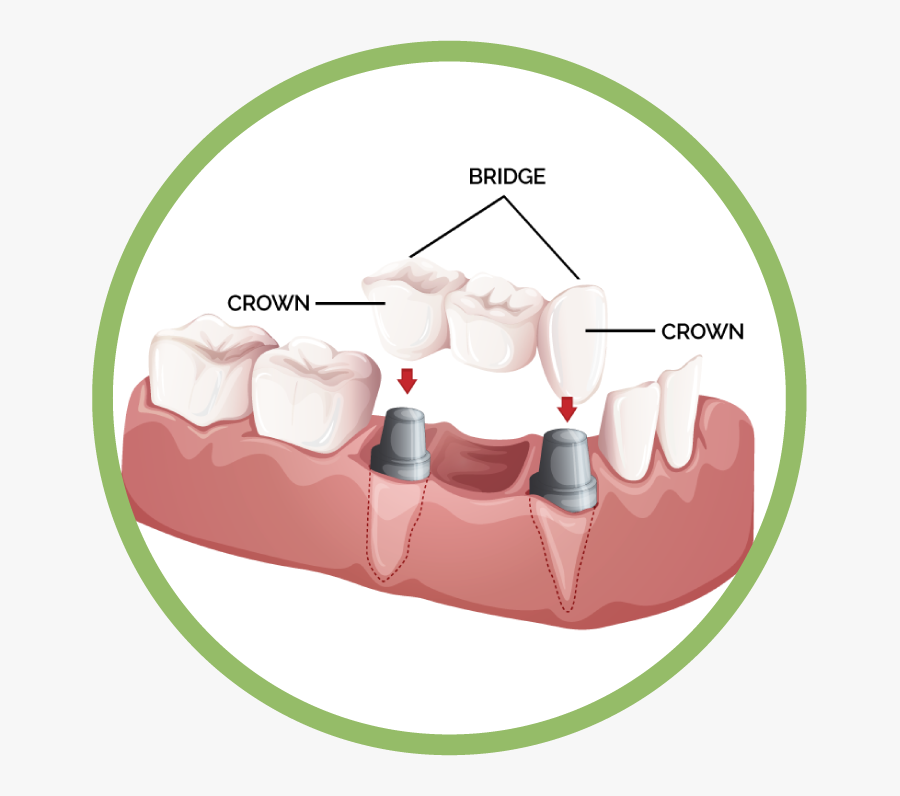 Dentures Clipart, Transparent Clipart