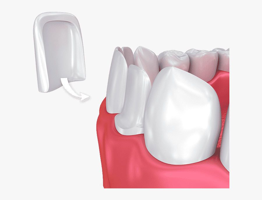 Dental Veneer, Transparent Clipart