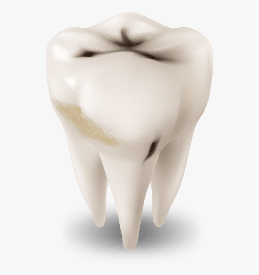 Tooth Decay Graphic - Fang, Transparent Clipart