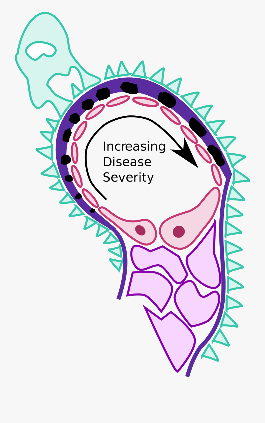 File Membranous Nephropathy Pathology Diagram Svg Wikimedia - Membranous Glomerulonephritis Spike And Dome, Transparent Clipart
