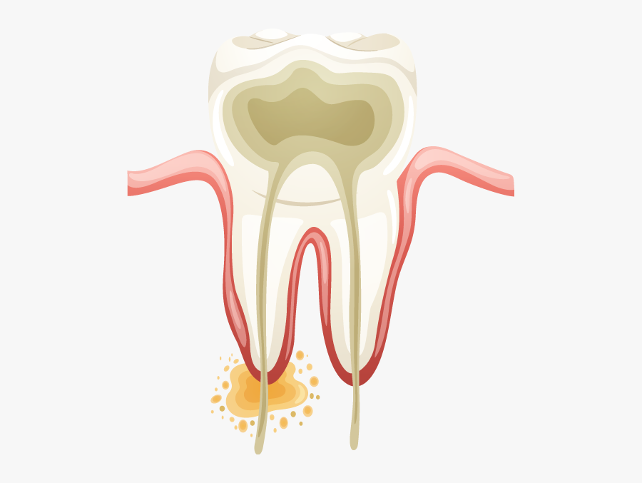 Cavity Treatment - Illustration, Transparent Clipart