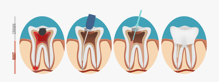 Root Canal Treatment, Transparent Clipart