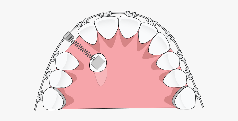 Isoglide Eruption Spring, Transparent Clipart