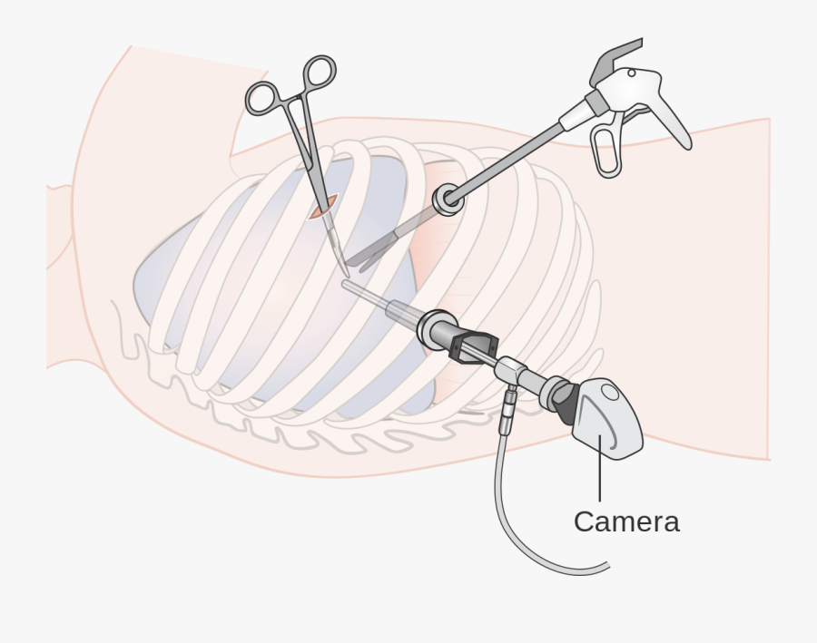 Thoracoscopic Lung Biopsy, Transparent Clipart
