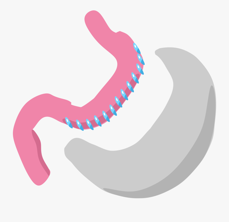 Gastric Sleeve Sleeve Gastrectomy, Transparent Clipart