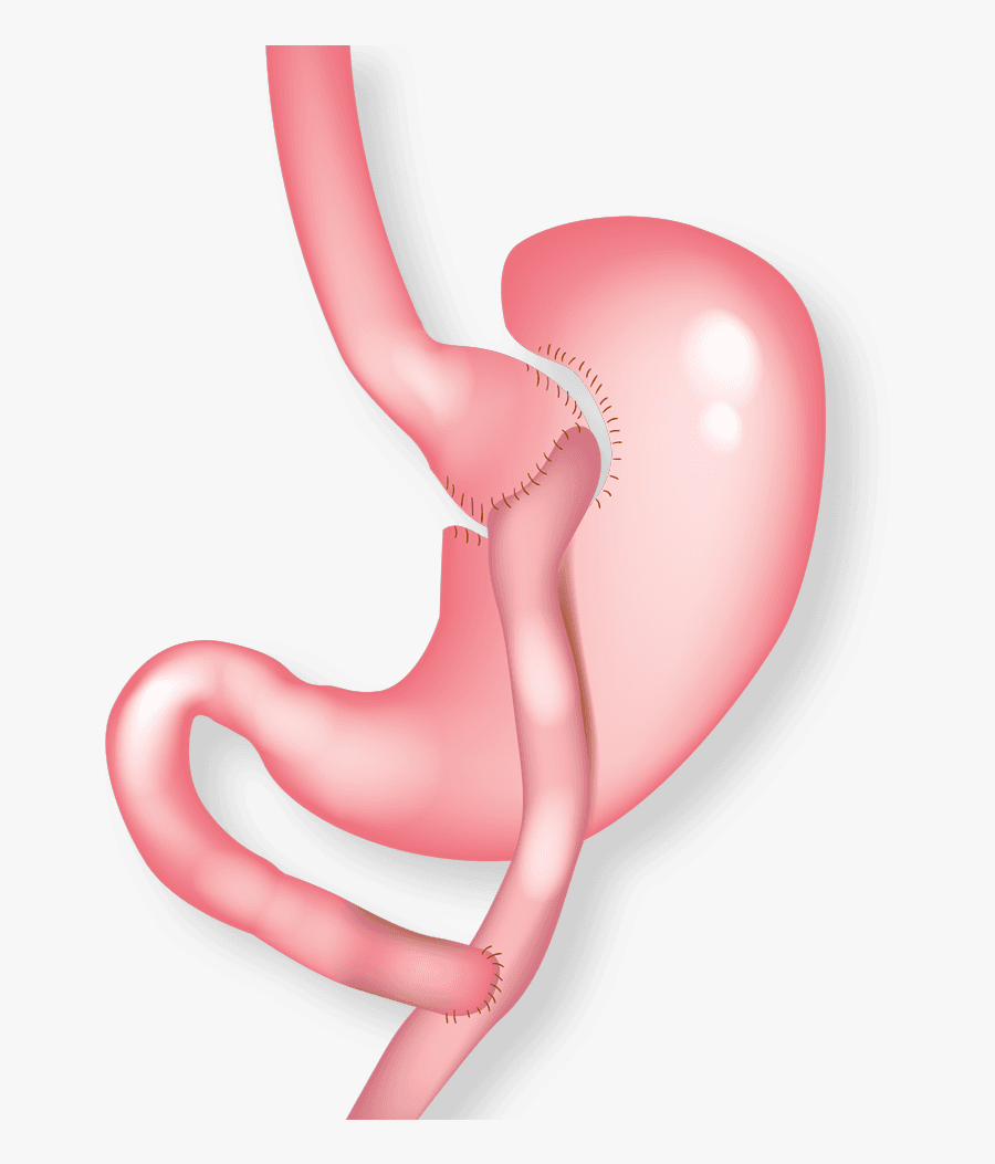 Illustration Of Gastric Bypass - Cirugia Bariatrica, Transparent Clipart
