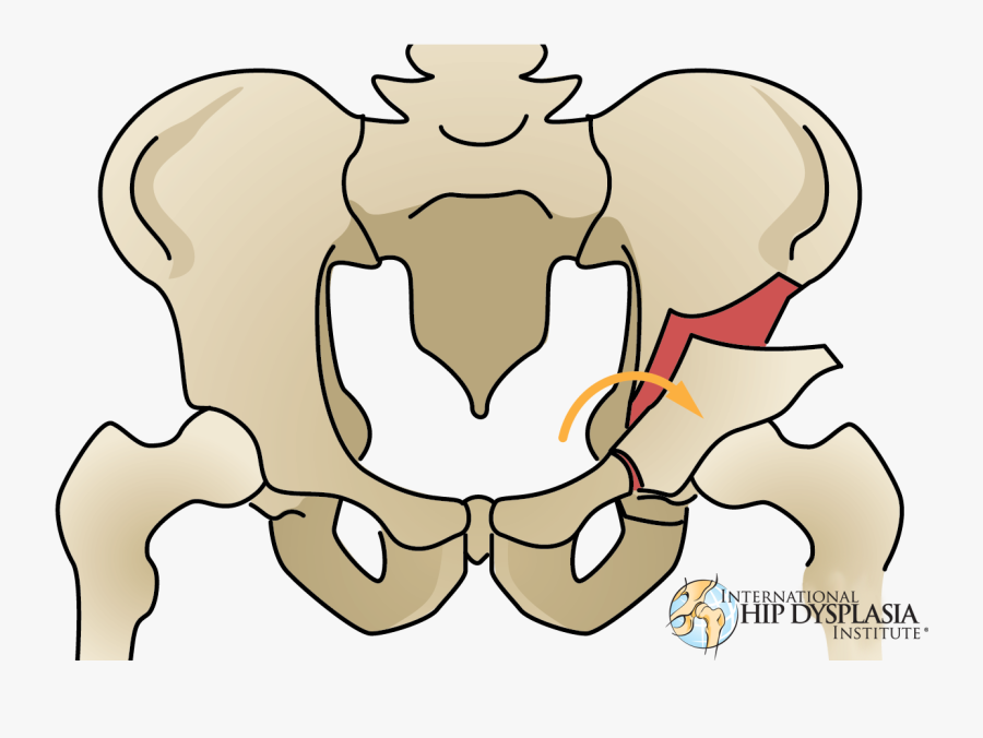 Salter Osteotomy, Transparent Clipart
