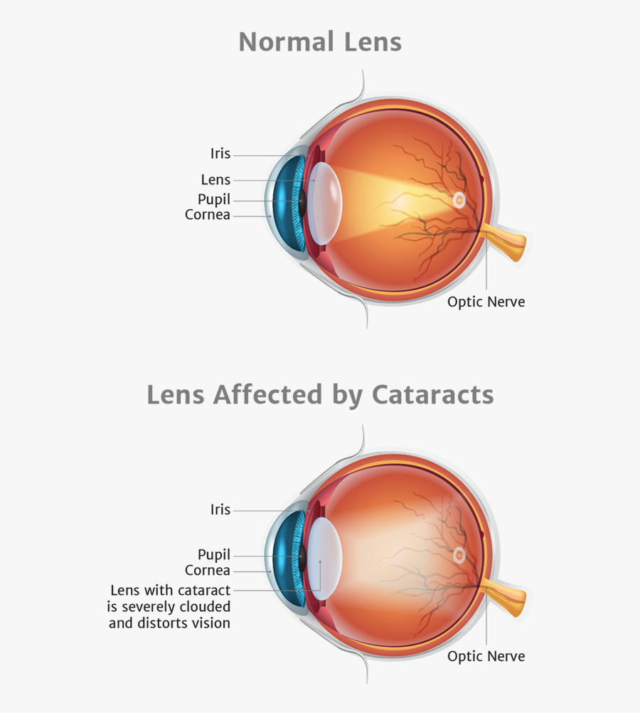 Illustration Of Lens Affected By Cataracts - Cataract Diagram, Transparent Clipart