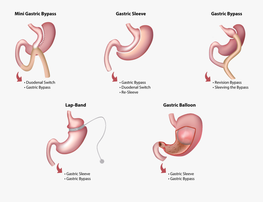 Sleeve To Mini Gastric Bypass, Transparent Clipart