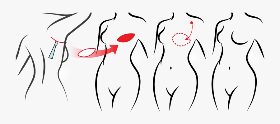 Icap Procedure, Transparent Clipart