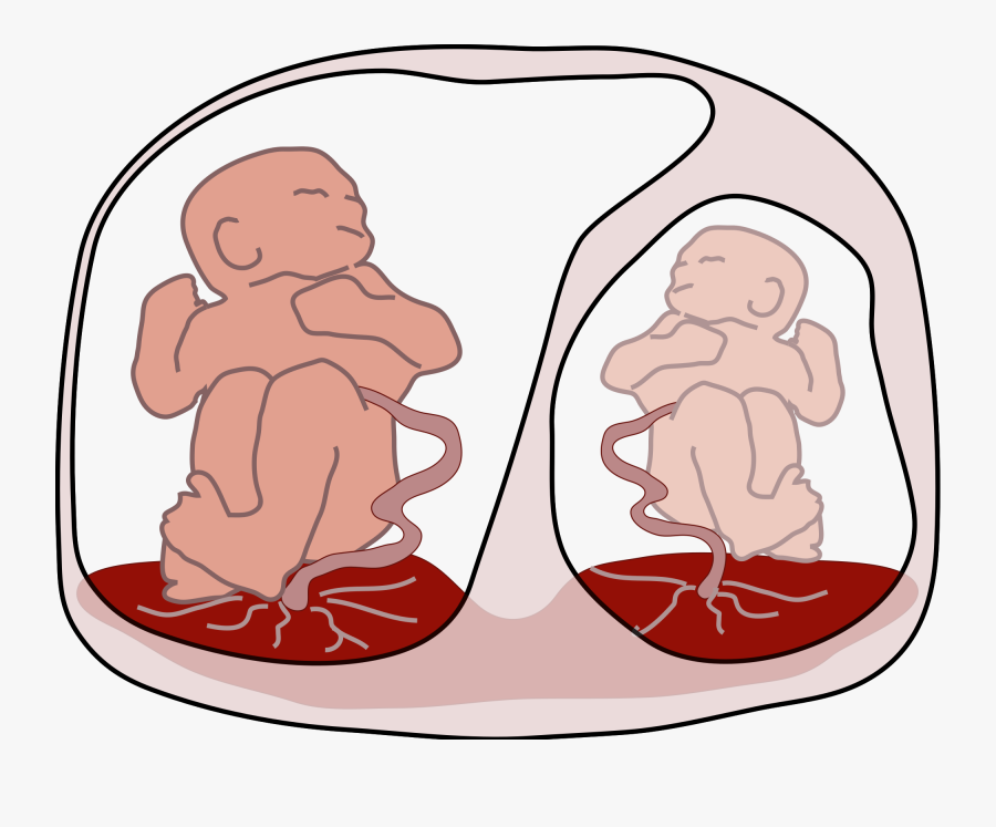 Twin To Twin Transfusion Syndrome Icd 10, Transparent Clipart