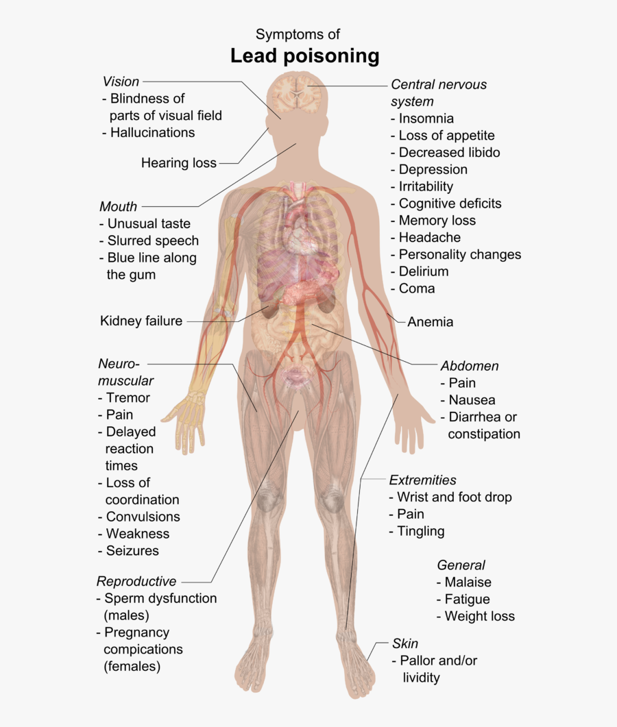 Stomach Pain Diagram Best Of Lead Poisoning Wikiwand - Symptoms Of Lead Poisoning, Transparent Clipart