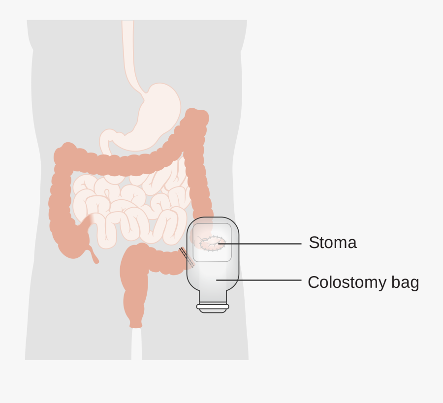 Stomach Pain Diagram Lovely Colostomy - Sztóma Zsák, Transparent Clipart