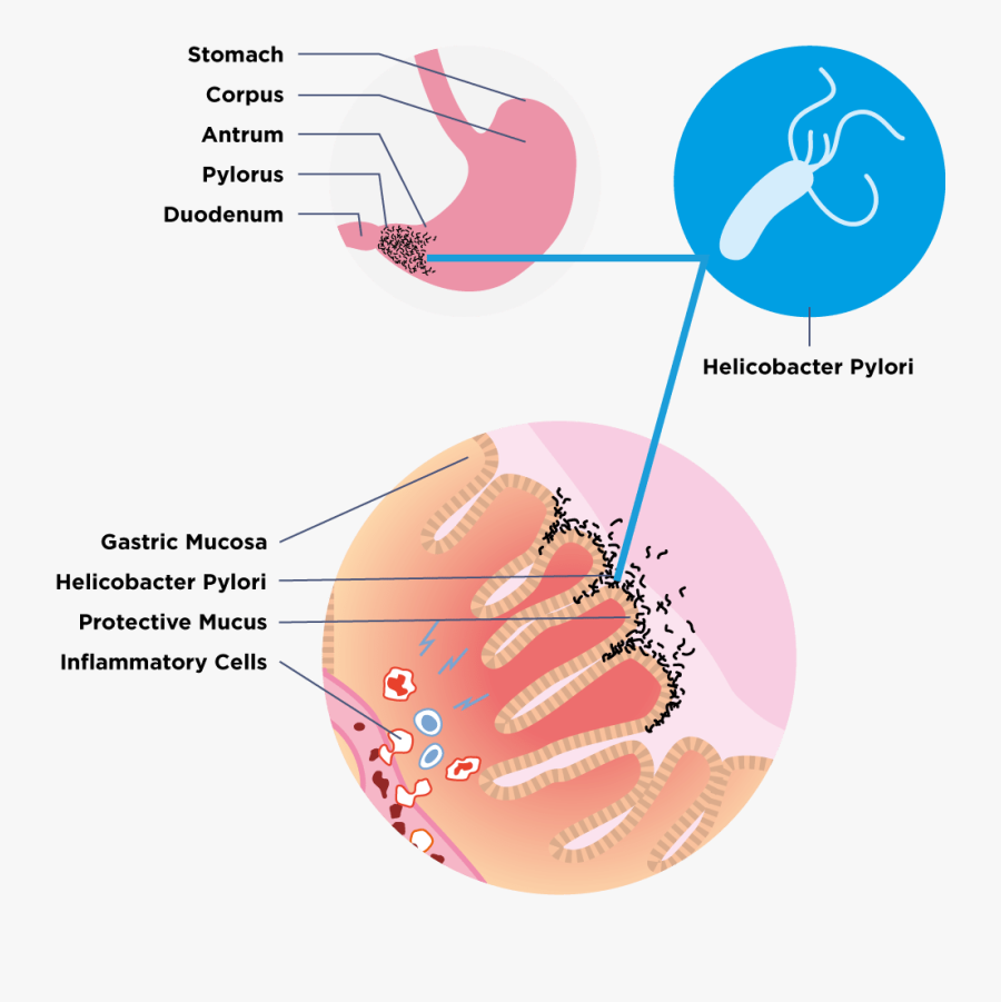 Does H Pylori Look Like, Transparent Clipart
