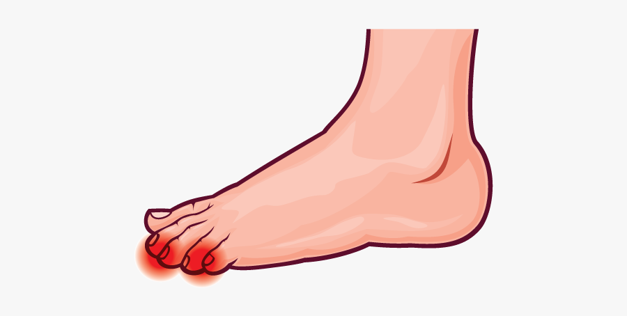 Foot Clipart Ankle - Flat Feet With Overpronation, Transparent Clipart