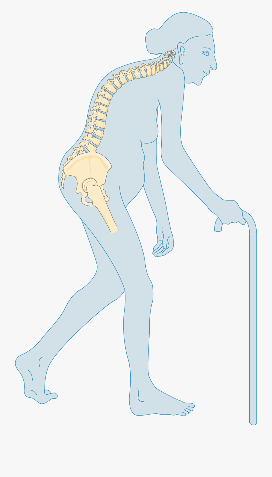 Severe Osteoporosis, Transparent Clipart