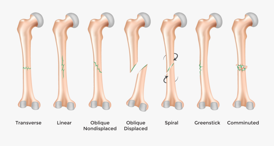Clip Art Broken Leg X Ray - Bones Fractures, Transparent Clipart