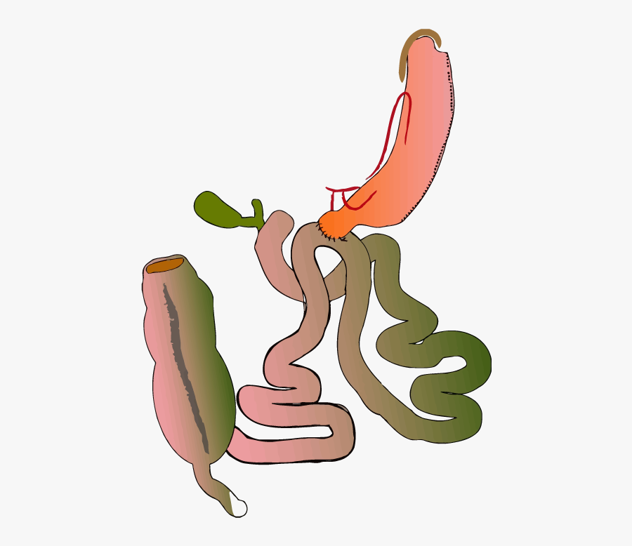 Intestinal Pylorus Sparing Surgery - Single Anastomosis Duodeno Ileal Bypass Sadi, Transparent Clipart