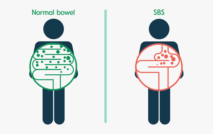 Transparent Intestine Png - Short Bowel Syndrome Patient, Transparent Clipart