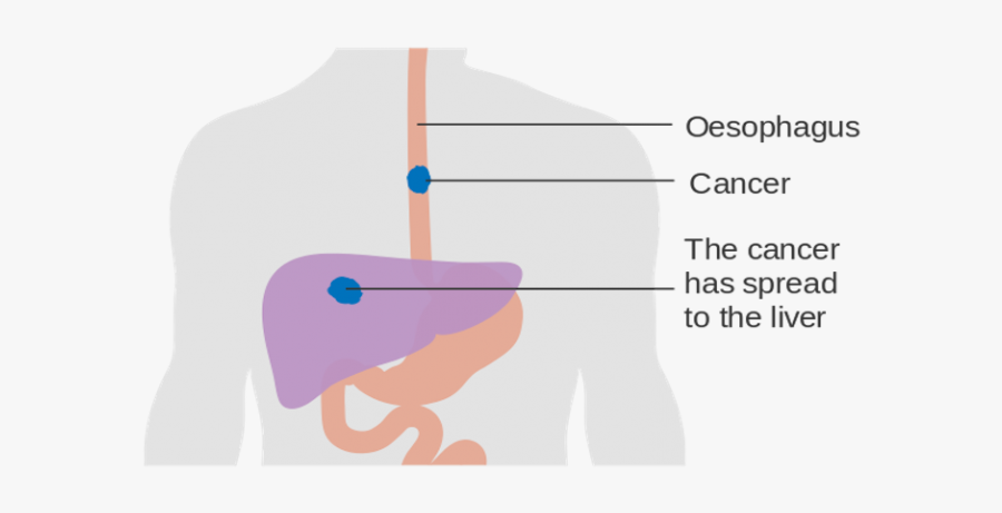 Countries With The Highest Rates of Esophageal cancer - Graphic Design, Transparent Clipart