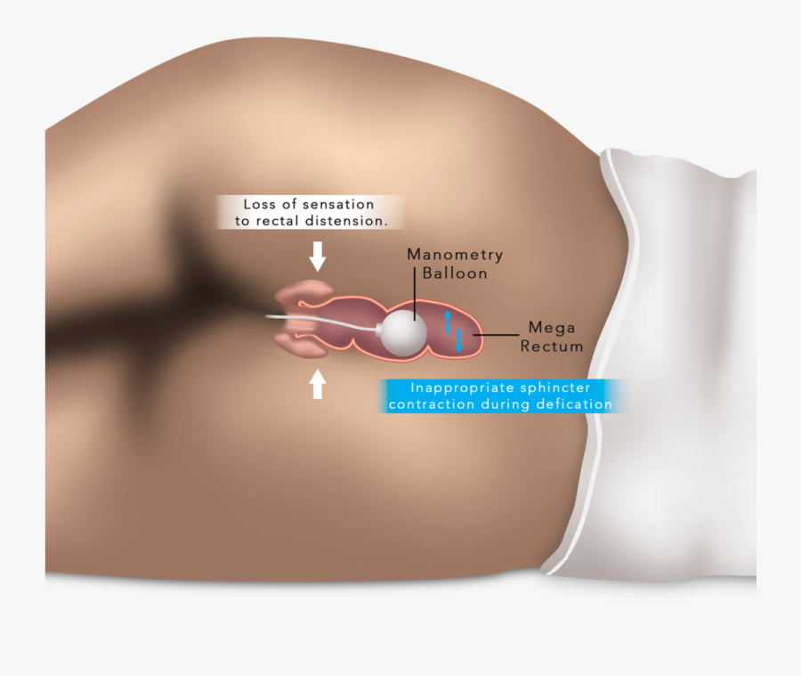 Esophageal And Anorectal Manometry - Anorectal Manometry, Transparent Clipart