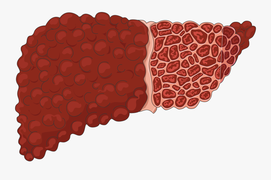 Cirrhosis Transparent, Transparent Clipart
