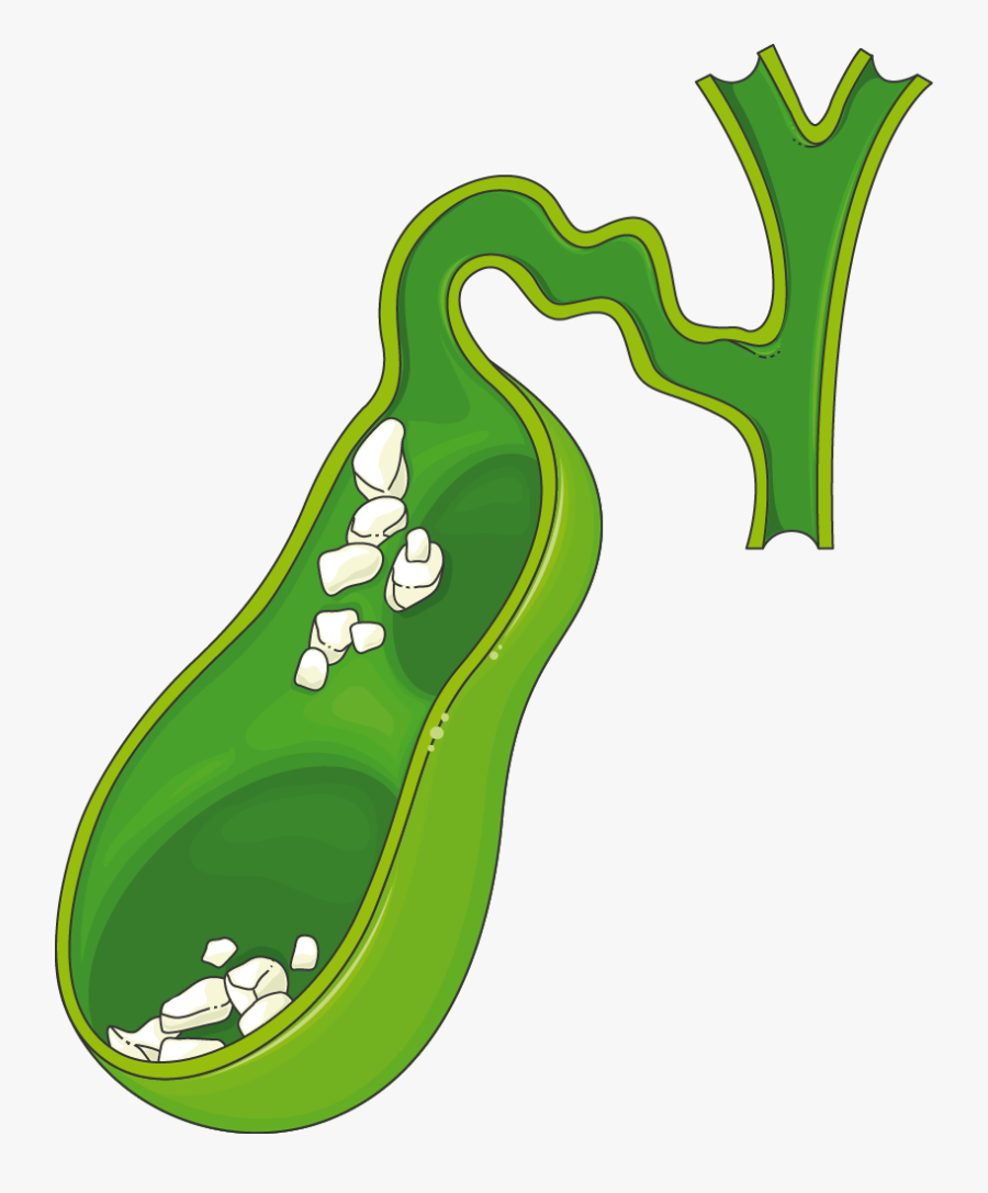 Lithiase - Biliary Lithiasis, Transparent Clipart
