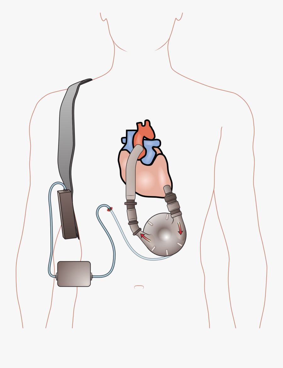 Ventricular Assist Device - Left Ventricular Assist Device Real, Transparent Clipart