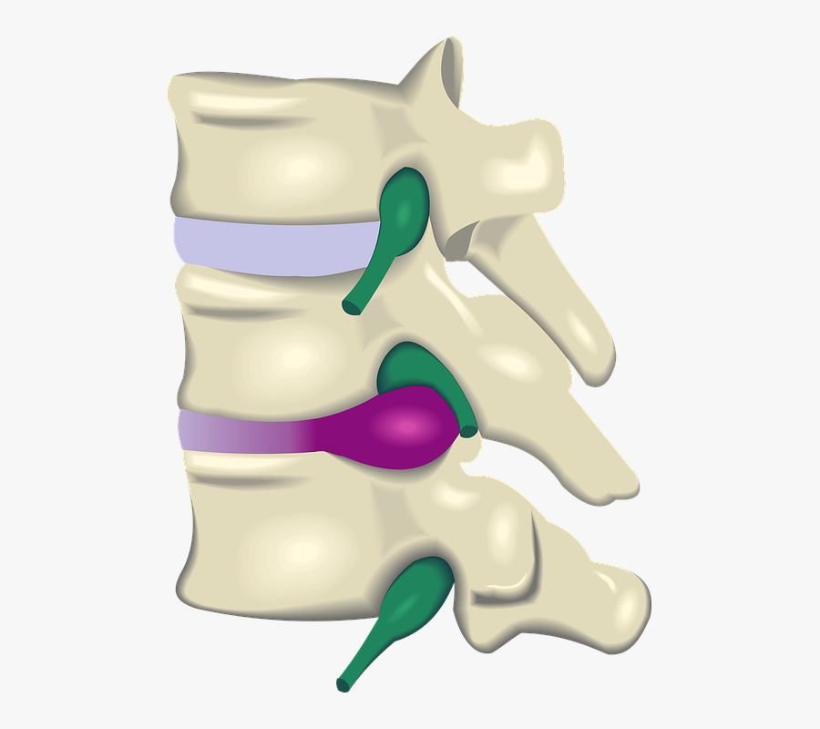Understanding Disc Injuries And - Disc Herniation Clipart, Transparent Clipart