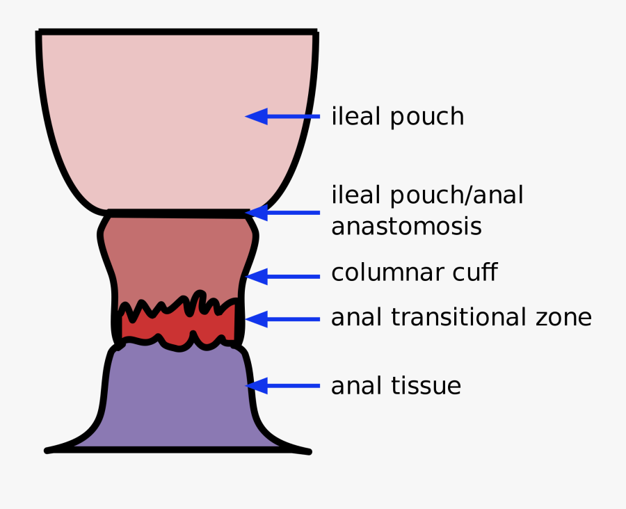 Hartmann's Rectal Stump Reversal , Free Transparent Clipart ClipartKey