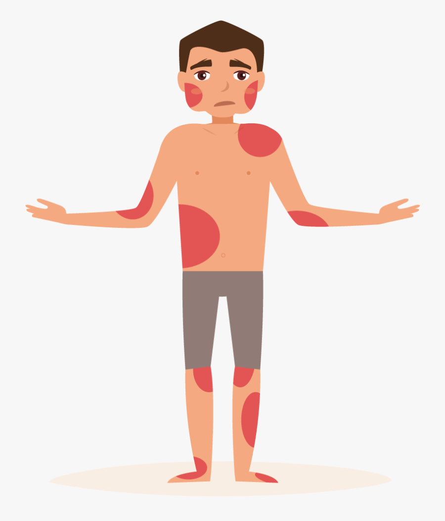 How To Treat Eczema - Clip Art Eczema, Transparent Clipart