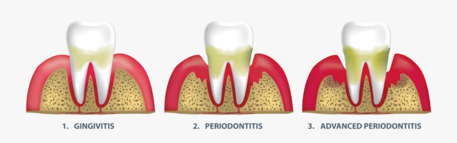 Stages Of Gum Disease Falls Church, Va - Gum Disease Sugar, Transparent Clipart