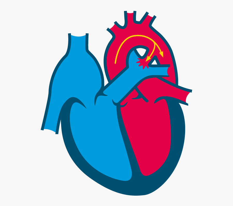 Patent Ductus Arteriosus, Transparent Clipart