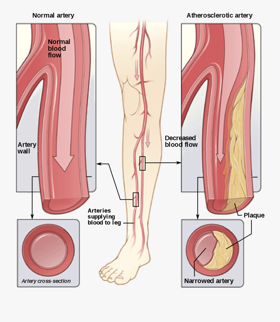 Peripheral Arterial Disease - Peripheral Arterial Disease Diagram, Transparent Clipart