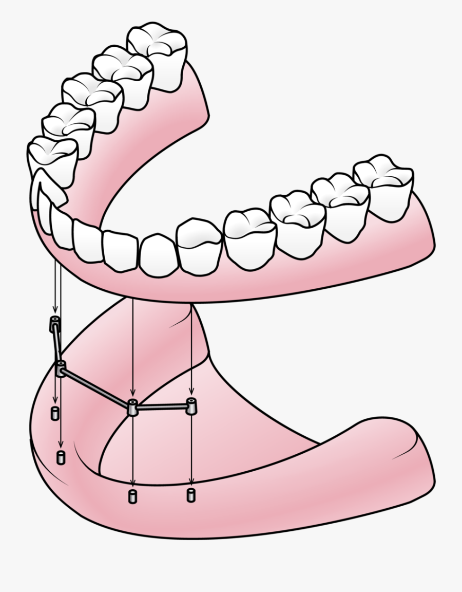 Full Partial Valley And - Implant Supported Denture Components, Transparent Clipart