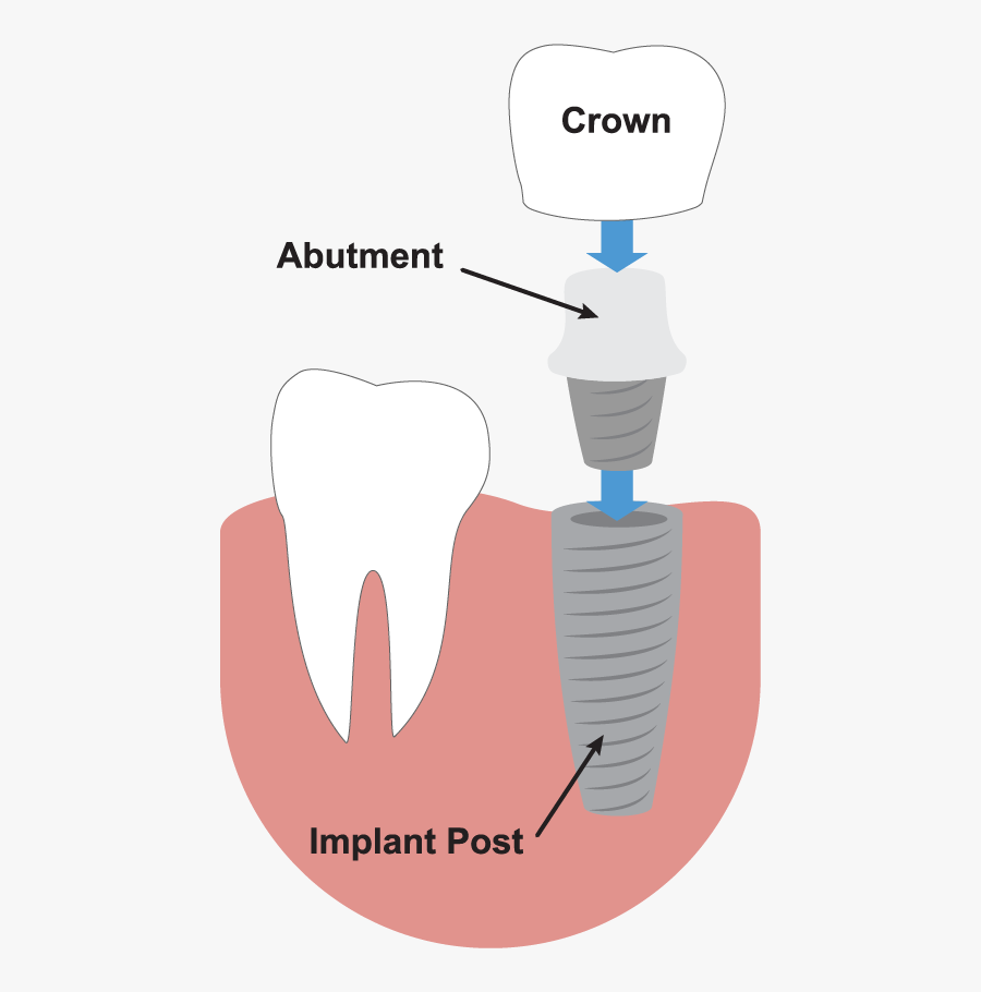 Transparent Tooth Outline Png - Dental Implant Illustration, Transparent Clipart