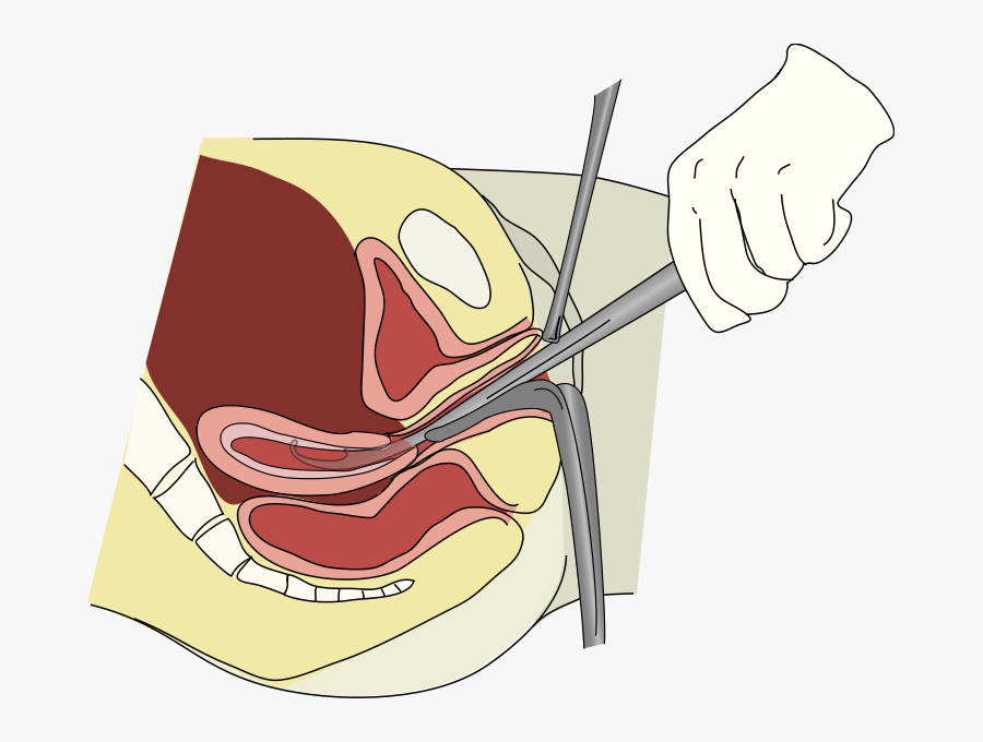 An Illustration Of The Principle Of Dilation And Curettage - Whats In A Rape Kit, Transparent Clipart