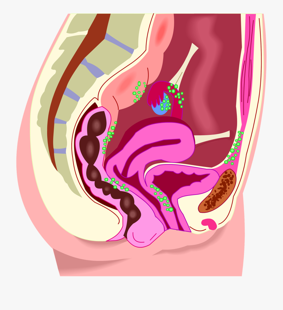 Endometriosis, Transparent Clipart