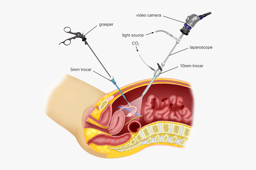 Minimally Invasive Surgery, Transparent Clipart