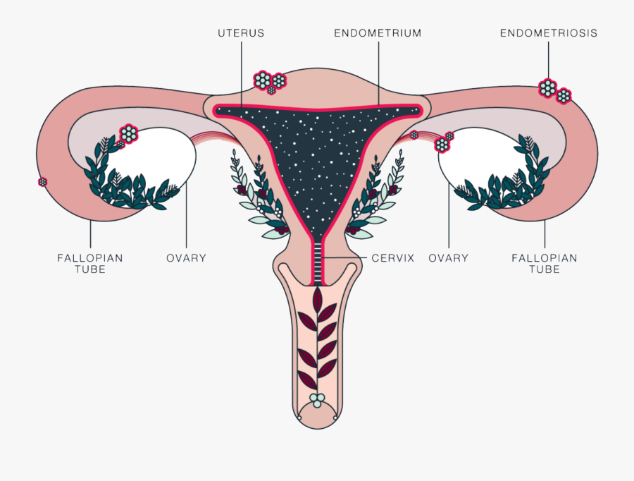 Endometriosis Center Nyc - Endometriosis, Transparent Clipart