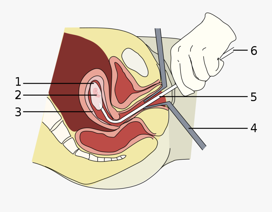 A Vacuum Aspiration Abortion At Eight Weeks Gestational - Abortion Meaning In Urdu, Transparent Clipart