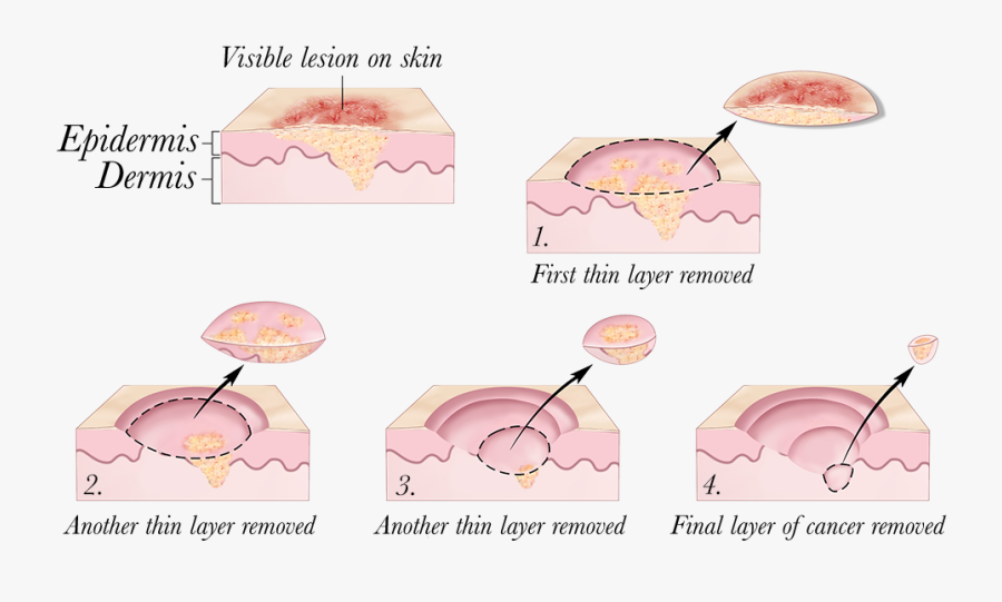 © 2010 Terese Winslow - Skin Cancer Treatment, Transparent Clipart