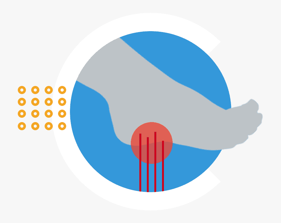 Plantar Fasciitis Symptoms - Circle, Transparent Clipart