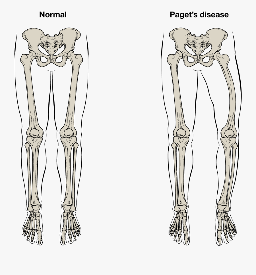 Paget Disease Of Bone Facts , Free Transparent Clipart ClipartKey