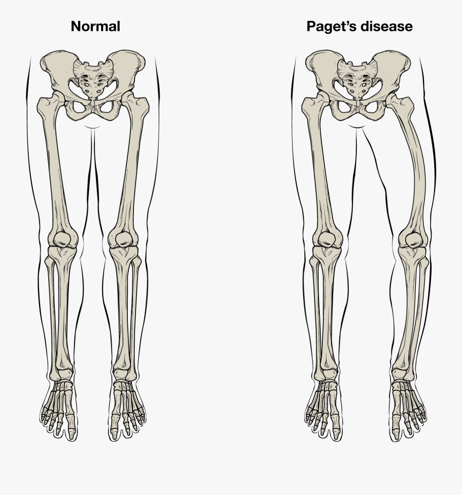 Paget Disease Of Bone Facts, Transparent Clipart