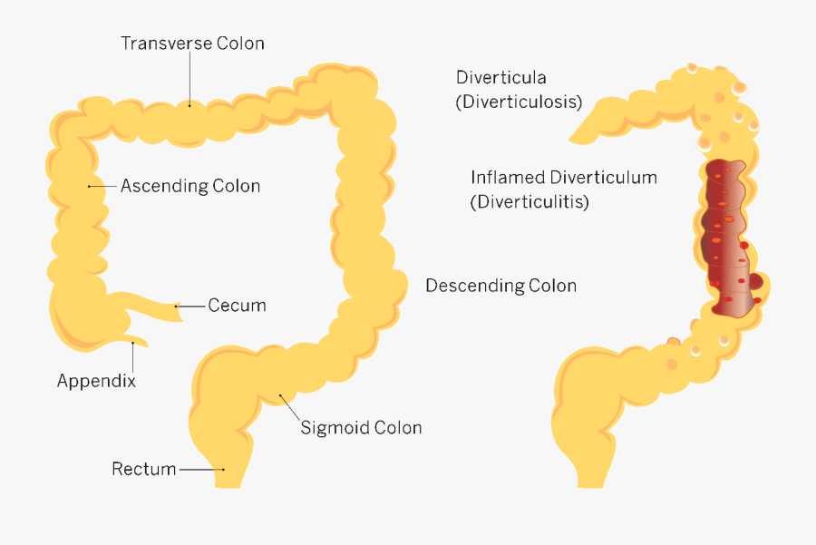 Transparent Intestines Png - Sigmoid Diverticulitis Icd 10, Transparent Clipart