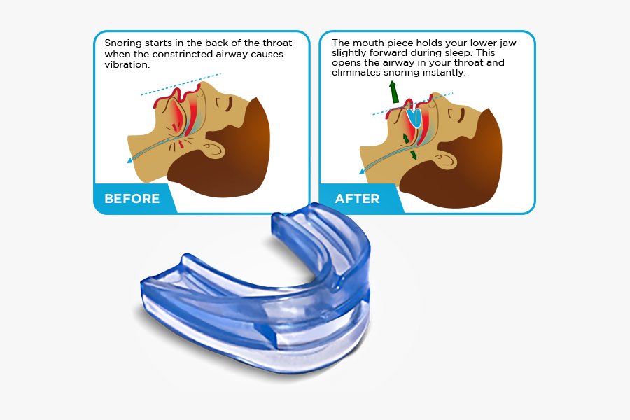 Person"s Mouth While They Sleep - Stop Snoring Devices, Transparent Clipart