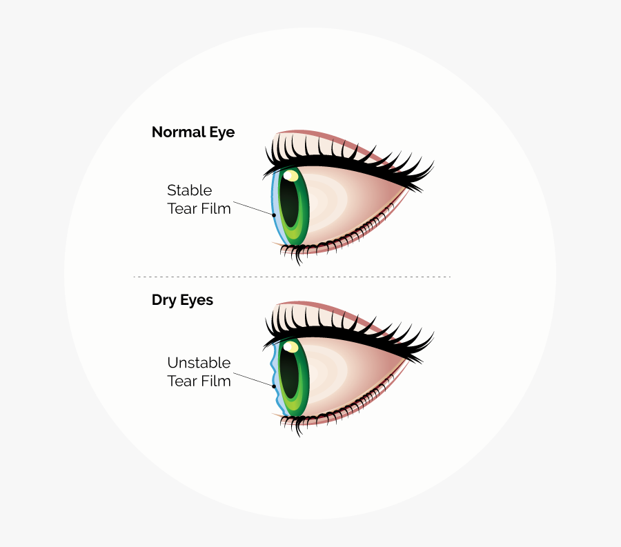 Dry Eye Syndrome Diagram, Transparent Clipart