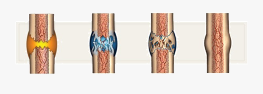 Soft Vs Hard Callus, Transparent Clipart