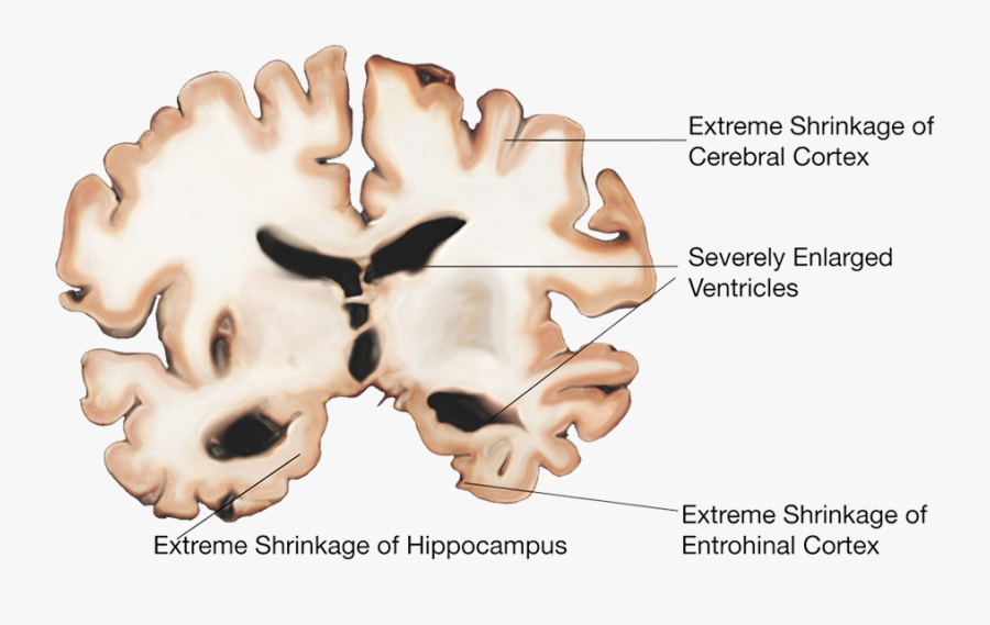 Transparent Alzheimer"s Disease Patient Clipart - Alzheimer's Disease Affects The Brain, Transparent Clipart
